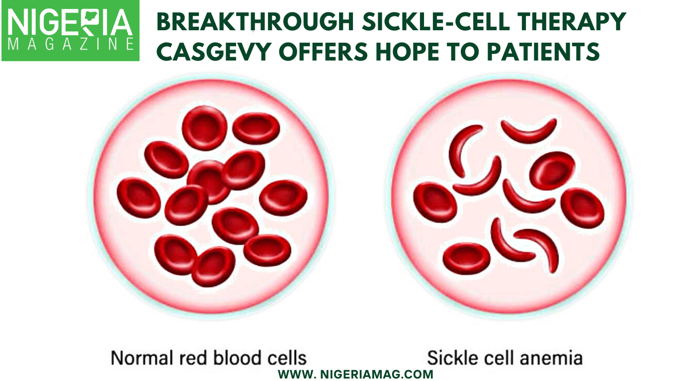 Breakthrough SickleCell Therapy Casgevy Offers Hope to Patients